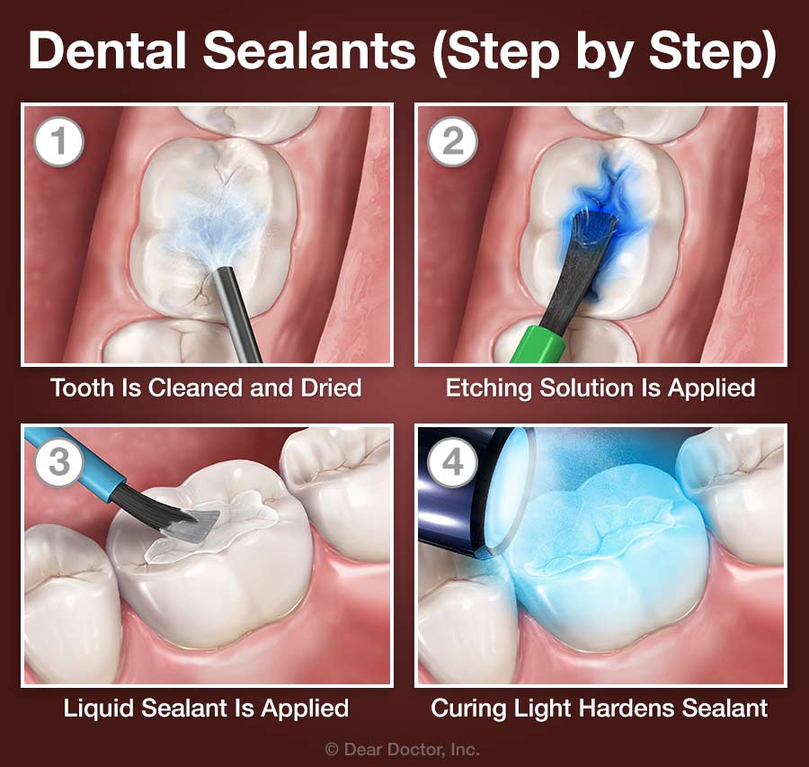 Dental Sealants step by step