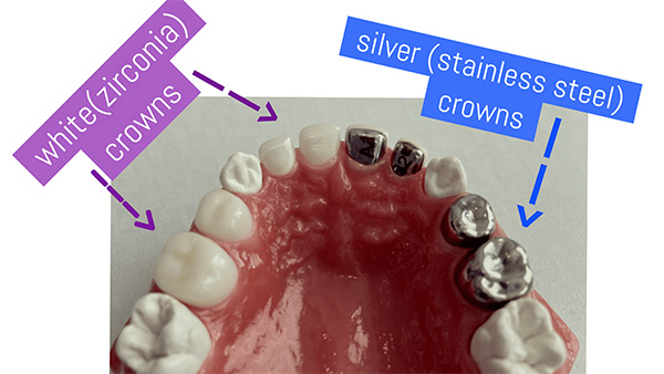 Zirconia vs Stainless Steel Crowns